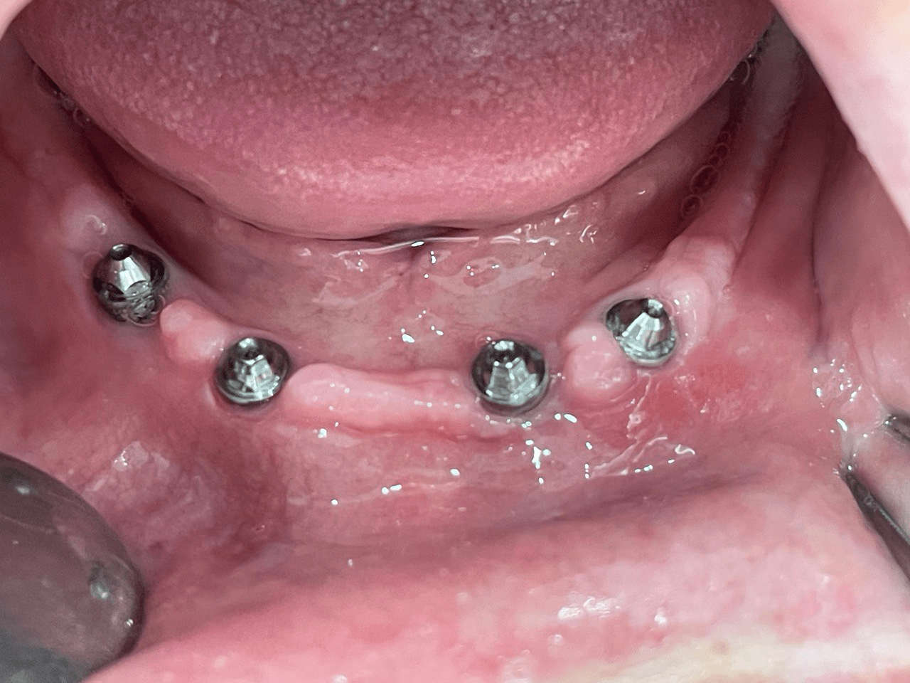 https://dentalplus.al/wp-content/uploads/2022/09/implanti-ipunimit-siper-min-2.png